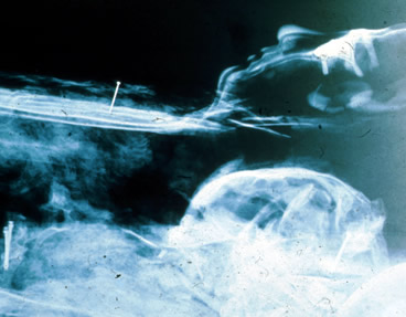 X-ray of Mummy 1770
